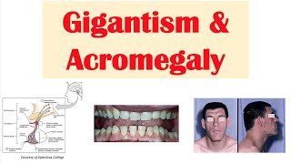 Gigantism amp Acromegaly  Growth Hormone Signs amp Symptoms Diagnosis Treatment [upl. by Quartis]