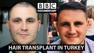 Hair Transplant Turkey  BBC Documentary  Paul Before amp After [upl. by Wernick]