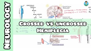 Crossed VS Uncrossed Hemiplegia  Neurology  USMLE NCLEX [upl. by Aldwon369]