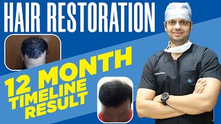 Hair Transplant Result in 2024  412 Month Hair Transplant Timeline  Best Hair Transplant Results [upl. by Janie12]