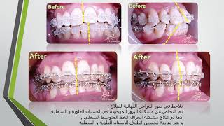 علاج بروز الأسنان العلوية و السفلية من خلال تقويم الأسنان Orthodontic treatment of teeth protrusion [upl. by Basham]