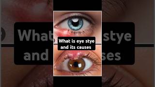 🙄Why do we get EYE STYE shorts viral health drMaryamgull [upl. by Enial]