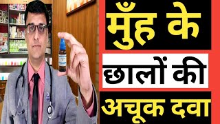 MOUTH ULCERS APHTHAE  मुँह के छालों की अचूक दवा  HOMEOPATHIC TREATMENT [upl. by Ysirhc517]