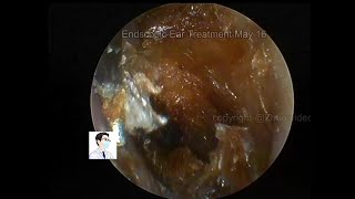 Reexamination of cholesteatoma of the external auditory canal 20220516 [upl. by Nauqyaj]