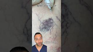 Removing Spider Veins With Sclerotherapy Treatments  Dr Somji Explains [upl. by Miran]