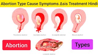 Abortion  Types of Abortion Types Cause Symptoms Diagnosis Treatment Hindi  Obstetrical Problem [upl. by Landa]