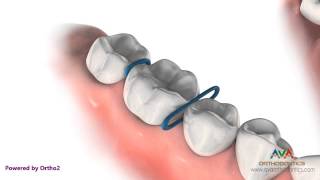 Orthodontic Separator or Spacer  Rubber ORings [upl. by Pavlov]