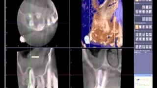 How to read a CBCT Cone Beam Computed Tomography Scan [upl. by Rambort313]