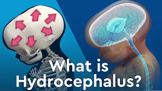 What is Hydrocephalus and Why Does Fluid Build Up in the Brain [upl. by Ashok676]