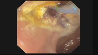 EUS evaluation and management of Ampullary lesions [upl. by Ashlee548]