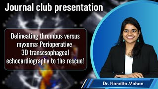 Journal Club Thrombus or Myxoma 3D Transesophageal Echocardiography to the rescue [upl. by Zashin]