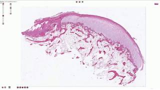 Ostechondroma  Histopathology [upl. by Demaria]