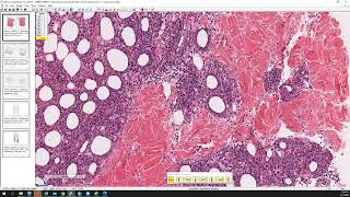 Subcutaneous panniculitislike Tcell lymphoma [upl. by Iffar]