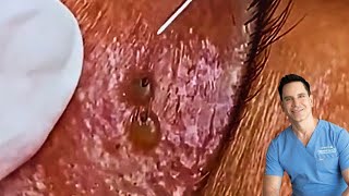 Blackheads on the eyelid Getting rid of eye blackheads [upl. by Annoeik]