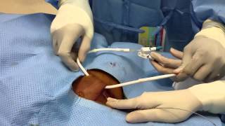 Tunneled Dialysis Catheter Insertion [upl. by Cyrill229]