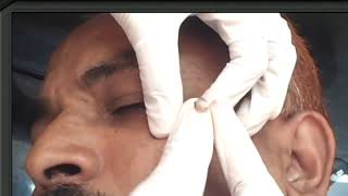 Painless removal of cyst by RF by Dr Bhutada Skin India [upl. by Williamson602]