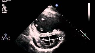 7B Parasternal short axis of the LV at the papillary muscle for LV eccentricity index PH [upl. by Eneroc]