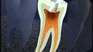 Root Canal Procedure [upl. by Margarete199]