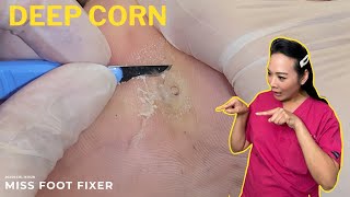 DEEP CORN REMOVAL😍 [upl. by Yelroc]