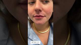 Lip fillers over time Skin Tightening Botox and Lip Fillers by Skinsation LA [upl. by Iba]