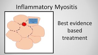 Myositis Inflammatory Myopathy Treatment [upl. by Eesyak]