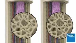 How osteoporosis develops  Bupa Health [upl. by Steen]