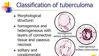 Secondary tuberculosis Focal tuberculosis Tuberculoma Infiltrative tuberculosis [upl. by Elyssa]