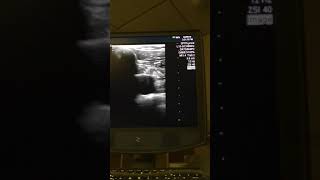 PulmCrit Shrug technique for ultrasoundguided subclavian [upl. by Modesta895]