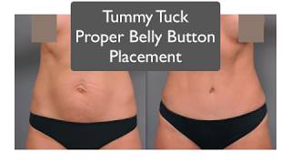 Belly Button Placement  Tummy Tuck Specialist Explains [upl. by Romano]