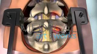 3D Medical Animation  Lumbar spine surgical procedure 2 level fusion of L4S1 [upl. by Yendis]