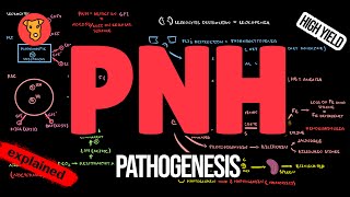 Paroxysmal Nocturnal Hemoglobinuria Pathogenesis Symptoms Diagnosis Treatment [upl. by Ilime64]