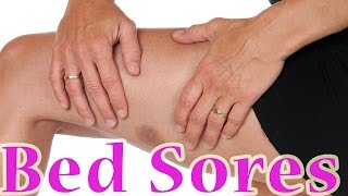 Bed Sores  Treatment For Bed Sores at Home  Pressure Ulcers Decubitus Ulcer Home Remedy [upl. by Aihsetel]