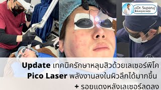 เทคนิครักษาหลุมสิวด้วยโปรแกรม Discovery Pico Laserพลังงานลงในผิวลึกมากขึ้น [upl. by Stockton]