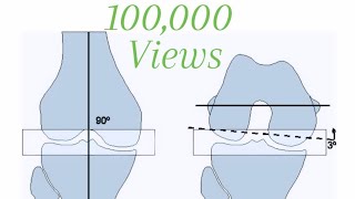 Total Knee Replacement Step by Step [upl. by Dnaleel]