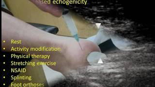 UltrasoundGuided Diagnosis and Treatment of Plantar Fasciitis [upl. by Craig]