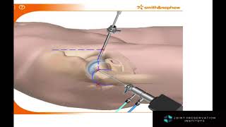 Hip Arthroscopy and FAI Treatment Animation [upl. by Oberg]