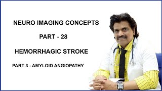 NEURO IMAGING CONCEPTS PART 28HEMORRHAGIC STROKE PART 3 AMYLOID ANGIOPATHY [upl. by Fanestil]