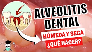 ALVEOLITIS DENTAL ¿Qué debo hacer Causas y Soluciones [upl. by Behrens]