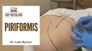 Dry Needling Piriformis [upl. by Binnings]