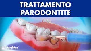 Trattamento parodontite – Curettage e sondaggio parodontale © [upl. by Curley810]