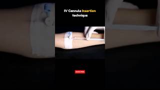 IV Cannula Insertion Technique 💉 iv ivy cannula cannulation [upl. by Delamare647]