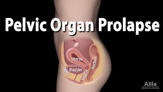 Pelvic Organ Prolapse Animation [upl. by Ahseena]