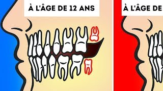 Aton Vraiment Besoin de Retirer Nos Dents de Sagesse [upl. by Ativad404]