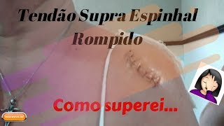 TENDÃO SUPRA ESPINHAL ROMPIDO  PRIMEIROS 15 DIAS tendaorompido ombrocongelado [upl. by Theta]