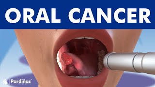 ORAL CANCER and tumors in the mouth lips and tongue © [upl. by Aititel]