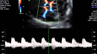 Flussimetria Doppler flussimetria arteria cerebrale [upl. by Einittirb]