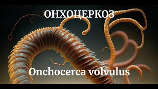 ОНХОЦЕРКОЗ Onchocerca volvulus МЕДИЦИНСКАЯ ПАРАЗИТОЛОГИЯ  Морфология Симптомы Диагностика Цикл [upl. by Einafpets]