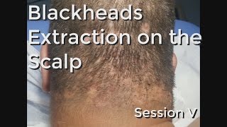 Blackheads Extraction on the Neck  Scalp  Session V [upl. by Ramuk904]