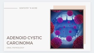 ADENOID CYSTIC CARCINOMA [upl. by Yerag]