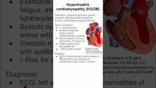 Hypertrophic cardiomyopathy HOCM [upl. by Roxane]